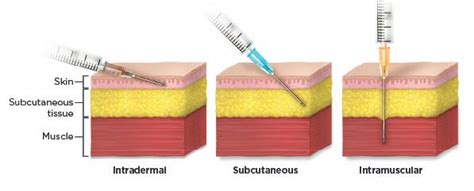 Study Medical Photos: Description Of Common Injection Sites