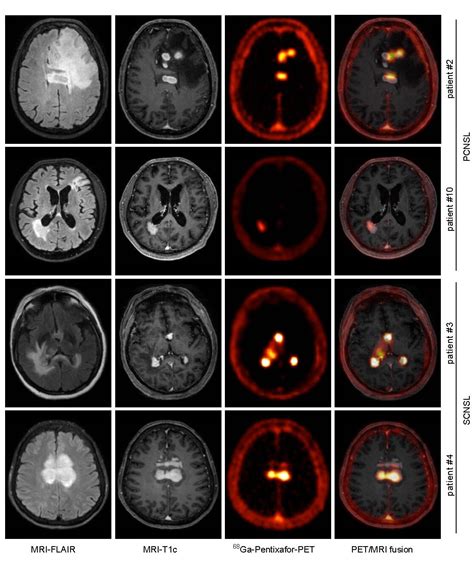 Pet Imaging Tracer Proves Effective For Diagnosing And Managing Rare