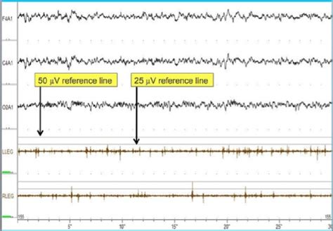 Manual Quantitative Assessment Of Amplitude And Sleep Stage