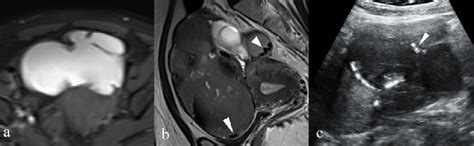 Endometrioma Mri Shows A A T1 Bright Multilocular Mass With B