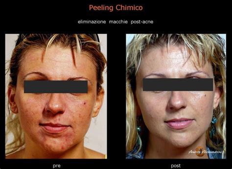 Peeling Chimico Medicina Estetica Roma