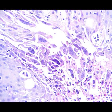 Herpes esophagitis (histology) | Radiology Case | Radiopaedia.org