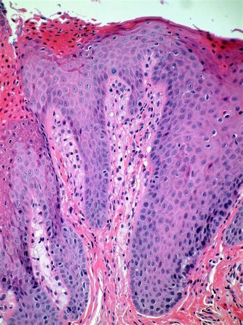 Oral Verruciform Xanthoma: A case report