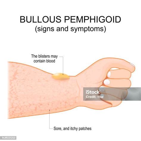 Bullous Pemphigoid Autoimmune Pruritic Skin Disease Stock Illustration