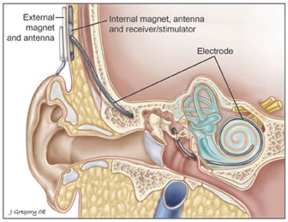 Cochlear Implants Surgery Risks NYEE