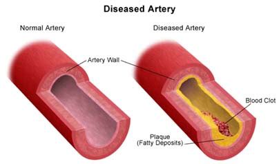 Surgery India Carotid Artery Stenosis,Cost Carotid Artery-Stenosis