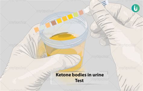 Ketones In Urine Signs Tests And Results Mantracare