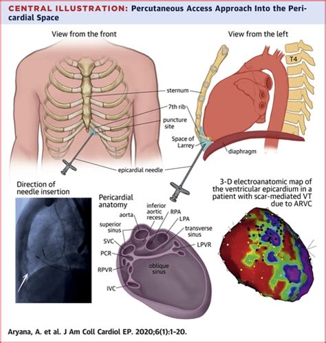 Percutaneous Epicardial Approach To Catheter Ablation Of Cardiac