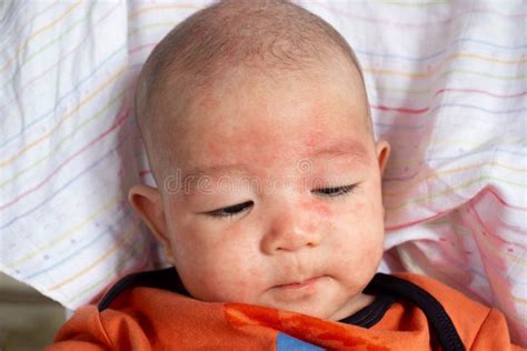 The Newborn Baby In Fant Has Face Allergy Or Rash Stock Image Image