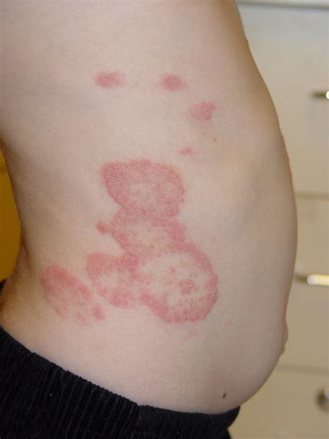 Tinea Corporis Symptoms Causes Diagnosis And Treatment