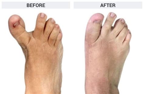 All About Bunion Treatments The Bunion Institute