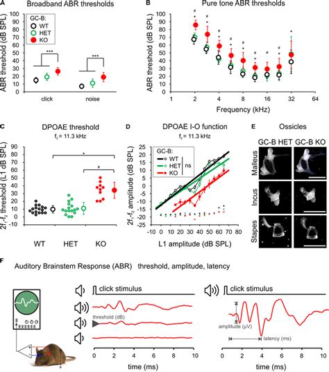 Mild Elevation Of Auditory Brainstem Response ABR And Distortion