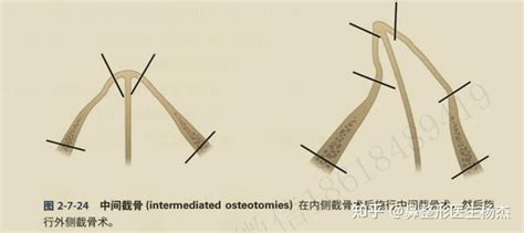 歪鼻的诊断、分类与矫正方法 知乎