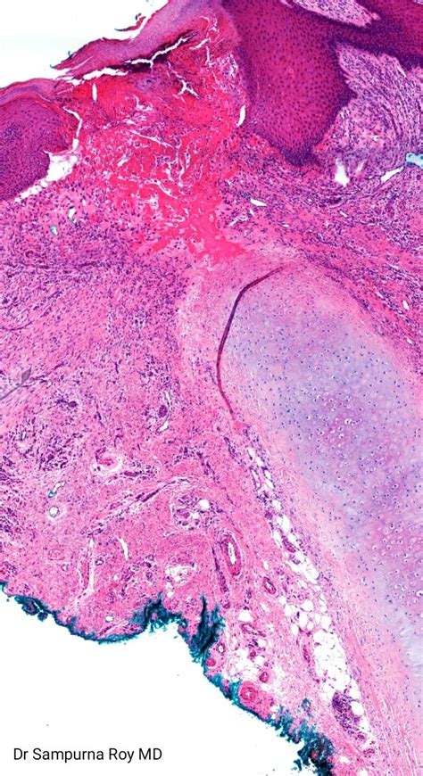 Pathology of Chondrodermatitis Helicis Nodularis | Medical school ...