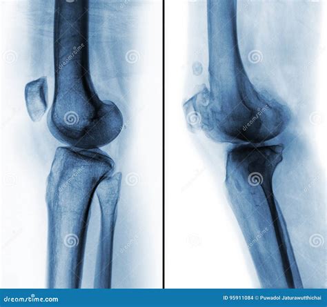 Comparison Between Normal Human Knee & X28; Left Image & X29; And