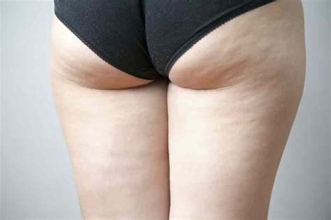 Che cos è la cellulite infettiva