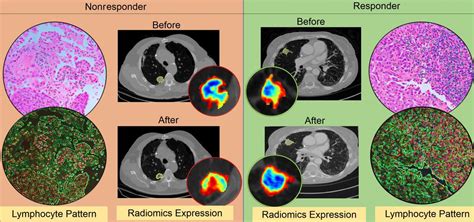 CT Radiomics Predicts Lung Cancer Immunotherapy Response