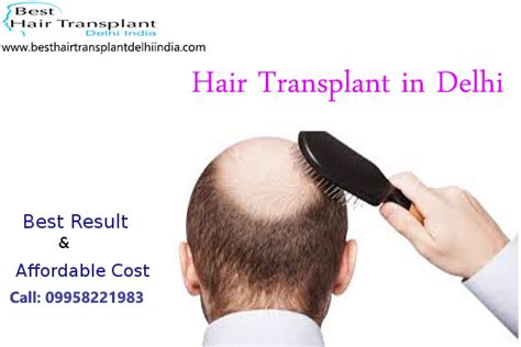 Hair Loss Treatments For Retaining Hairs And Transplant To Regain Them Artificially Best Hair