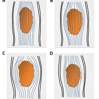 Diffusion Tensor Imaging DTI Analysis Of Spinal Cord A Axial