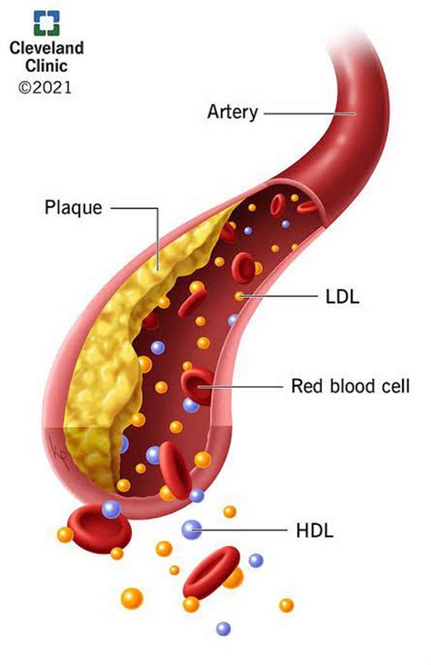 Hyperlipidemia MEDizzy