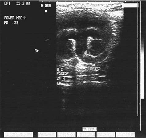 [pdf] Comparison Of Excretory Urography Ultrasonography Guided