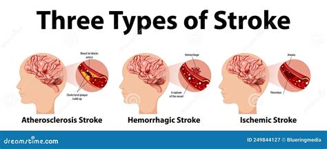 Infographic Of Common Types Of Stroke Stock Vector Illustration Of