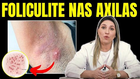 Qual O Melhor Rem Dio Para Foliculite Nas Axilas Revelado Youtube