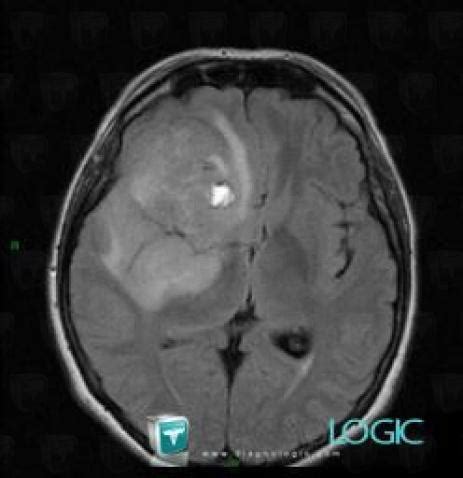 Radiology Case Glioblastoma Multiforme MRI Diagnologic