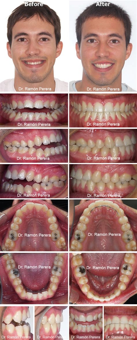 Class Iii With Open Bite Master Damon