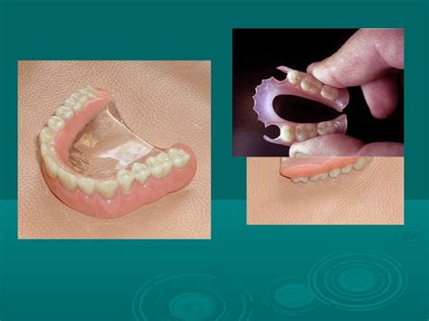 Denture Bases Orthodontic Courses By Indian Dental Academy