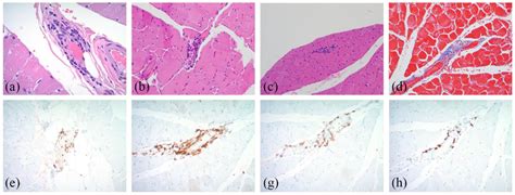 Pathology Findings Of The Left Quadriceps Biopsy H E Stains Of A