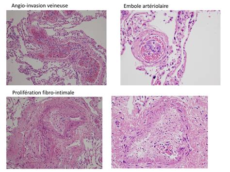 Microangiopathie Thrombotique Tumorale Pulmonaire Ppt T L Charger