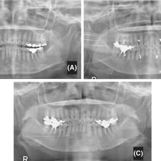 Panoramic Radiograph Of Case A Preoperative B One Day After The