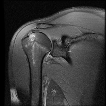 Hill Sachs Fracture And Bankart Lesion Sequelae Of Anterior Shoulder