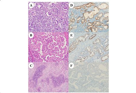 Histology And Immunohistochemistry Of The Recurred Tumor The Tumor Had