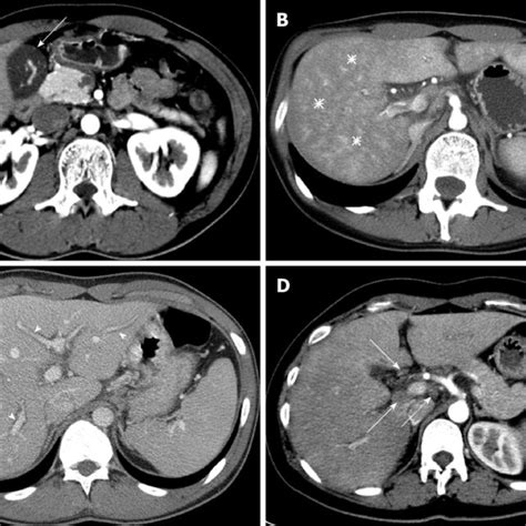 Typical Multi Channel Computed Tomography Findings In Patients With