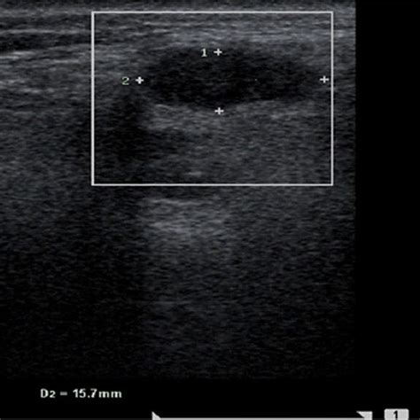 Ultrasonography Shows A Slight Dilation Of Left Submandibular Gland