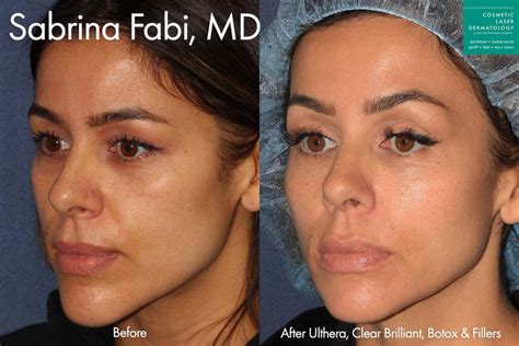 Botox To Lift Sagging Eyebrows San Diego Ca Clderm