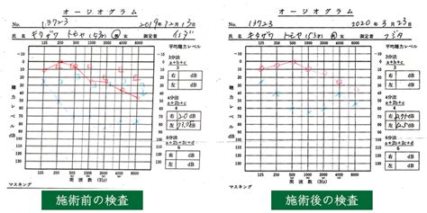 加齢性難聴｜名古屋市緑区のよもぎ鍼灸整骨院