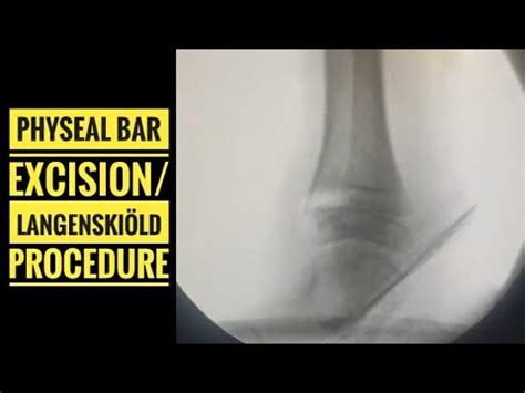 Physeal Bar Excision Langenski Ld Procedure Detailed Hd Surgical