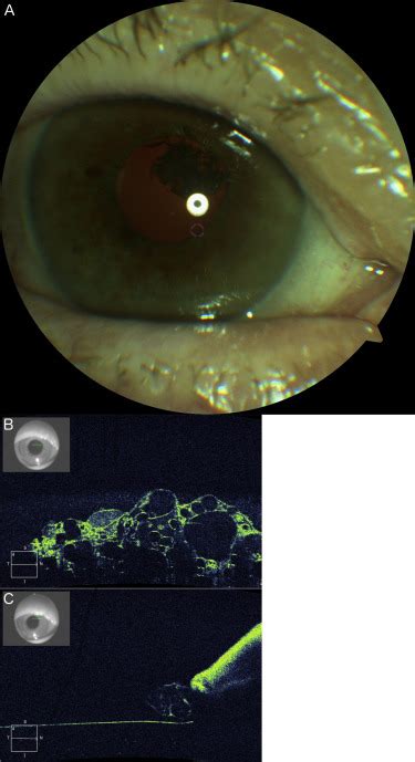 Oct Of Anterior Capsular Opacification In The Visual Axis Ophthalmology