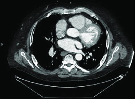 Chest CT With Contrast Demonstrating The SVC Feeding Into The Right