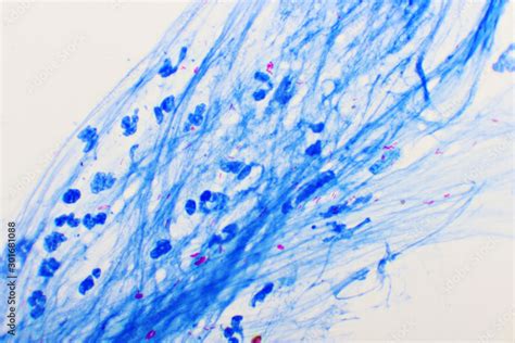 Mycobacterium Tuberculosis Positive Small Red Rod In Sputum Smear Acid Fast Stain Analyze By