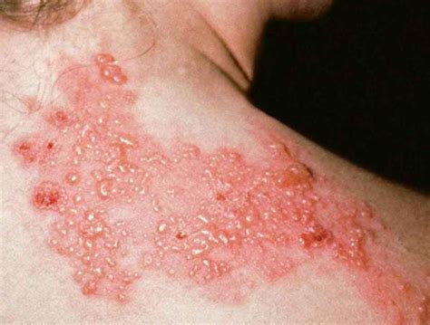 Zona Hastalığı Herpes Zoster Nedir Belirtileri ve Tedavi Yöntemleri