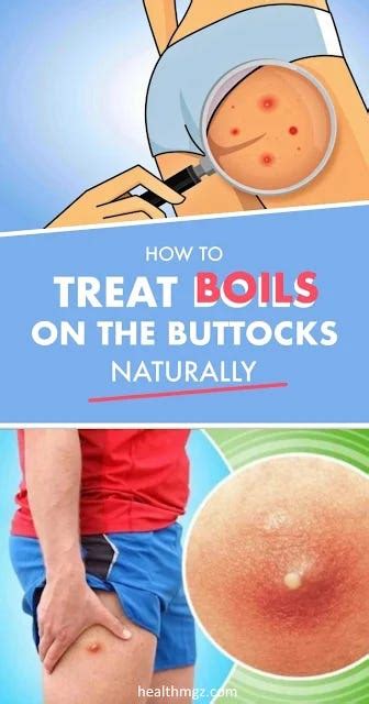 Get Rid Of The Boils On The Buttocks And Thighs Tiffiny Medium