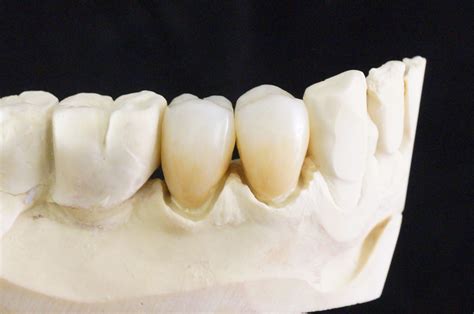 Ips E Max Porcelain Crowns Olivadds Dental Restoration