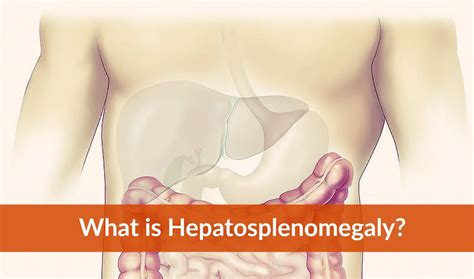 Hepatosplenomegaly What Is Causes Symptoms Treatment Etc