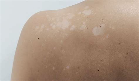 How To Get Rid Of White Spots From Tanning What S Causing It