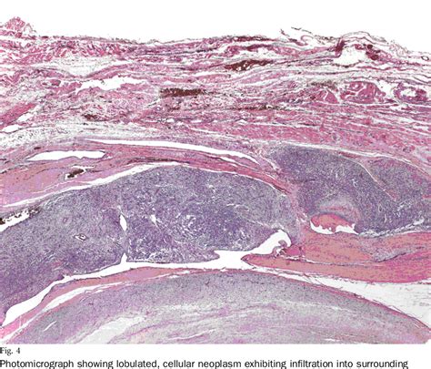 Figure 1 From Poorly Differentiated Synovial Sarcoma Of The Lumbar