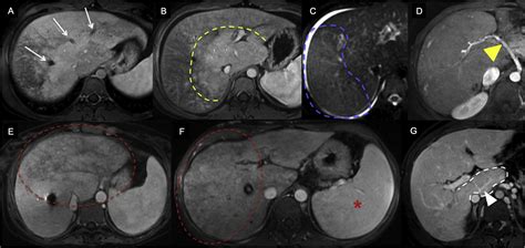 Budd Chiari Syndrome And Hepatic Regenerative Nodules Magnetic